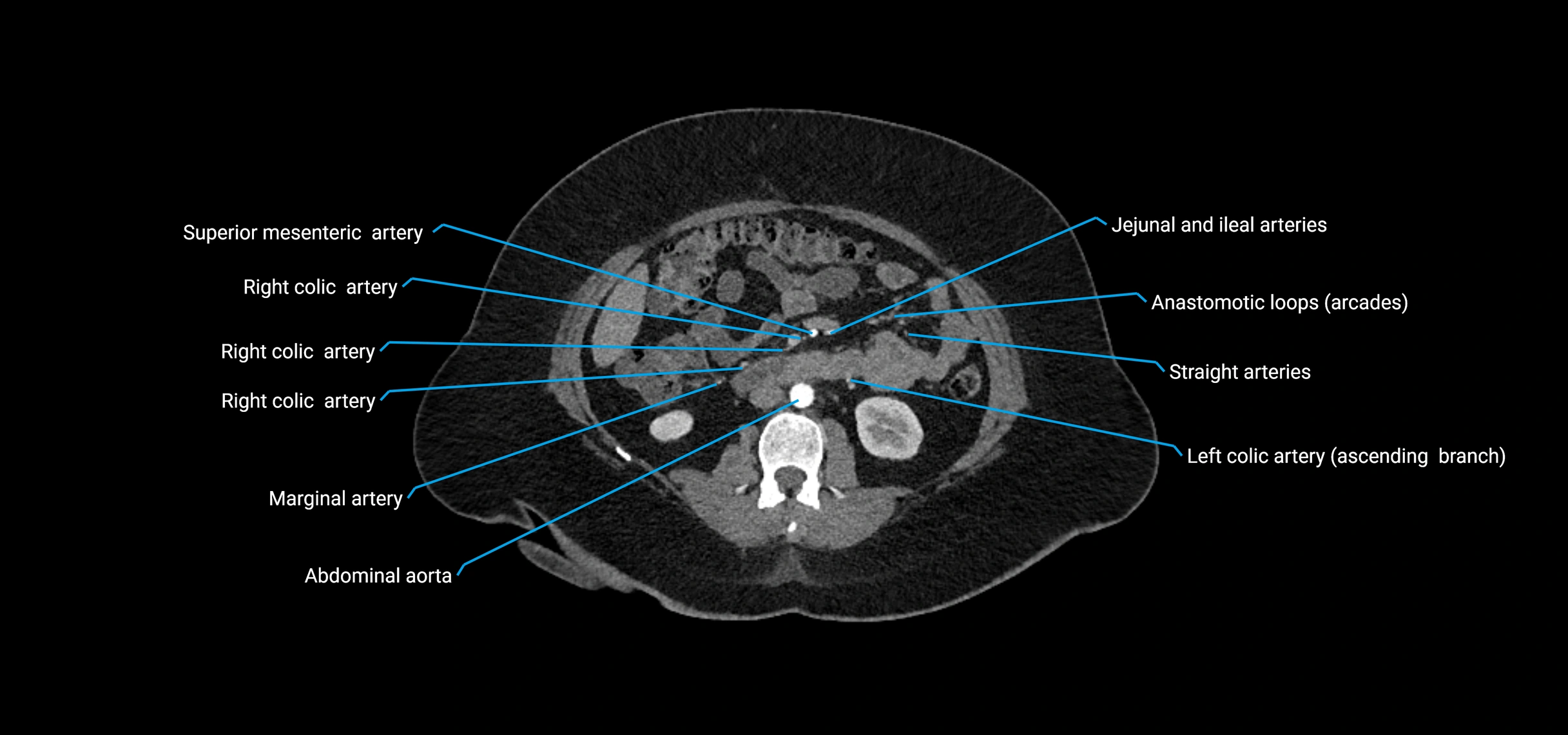 CTA abdomen axial cross sectional anatomy labelled image_93 (2).webp